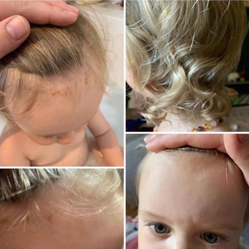 Sensitive but Stylish: Balancing Eczema, Dry Scalp and Curly Hair Care